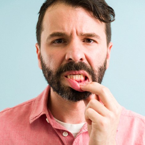 Man in pink shirt showing signs of gum disease in Fort Mill, SC