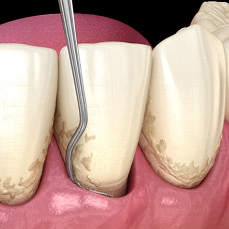 Illustration of scaling and root planing as gum disease treatment in Fort Mill, SC